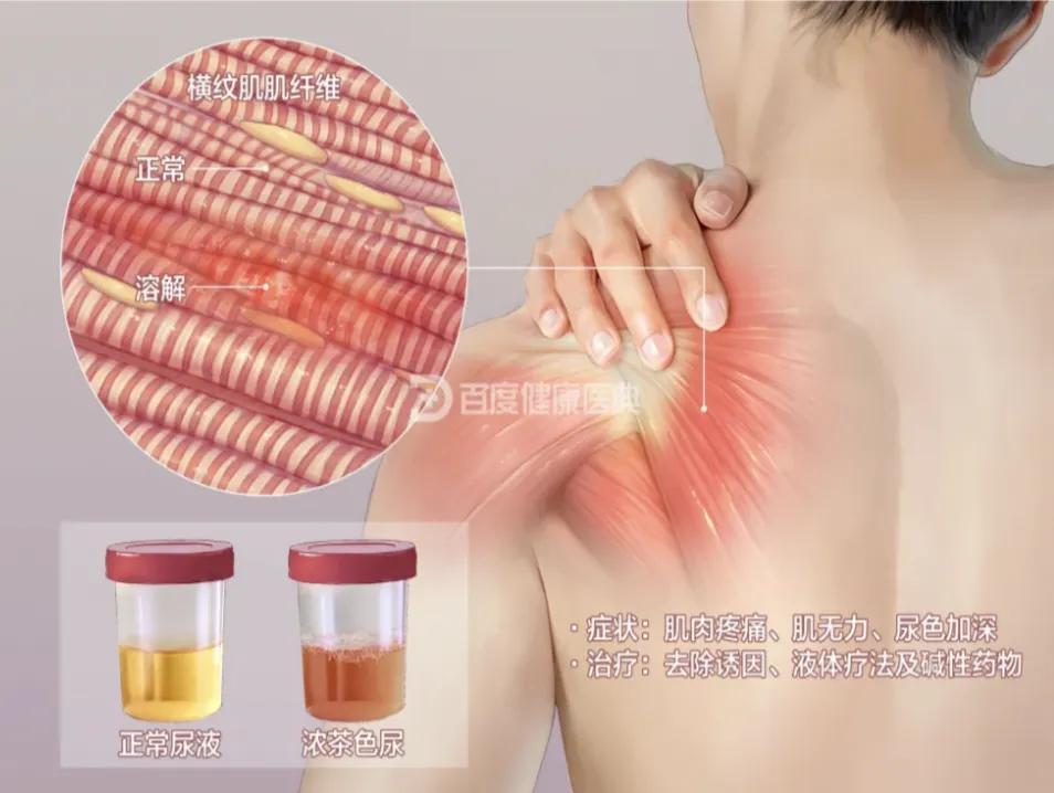 开云体育下载-警惕！小心这些药正在“溶解”你的肌肉